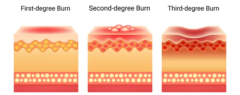 degrees of skin burns